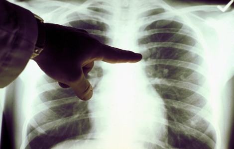 xray of lung